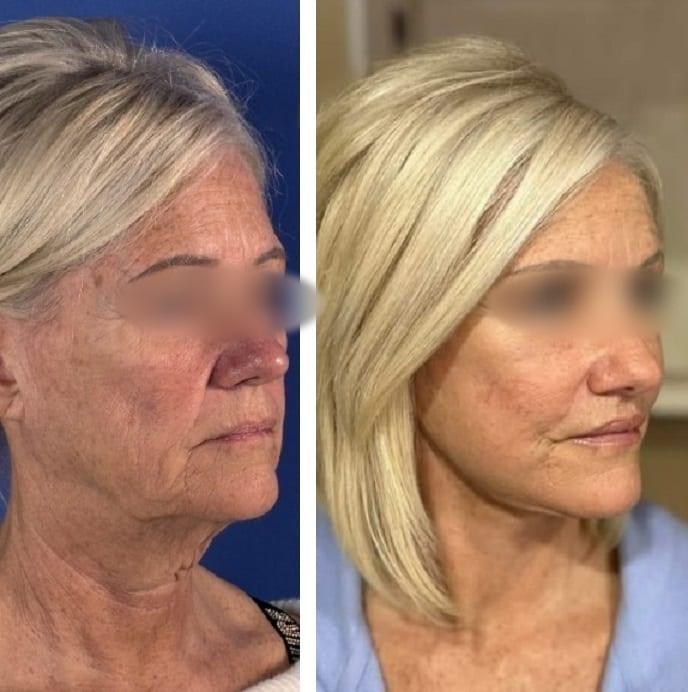 Lifting Facial y Cuello caso 1 — antes y después